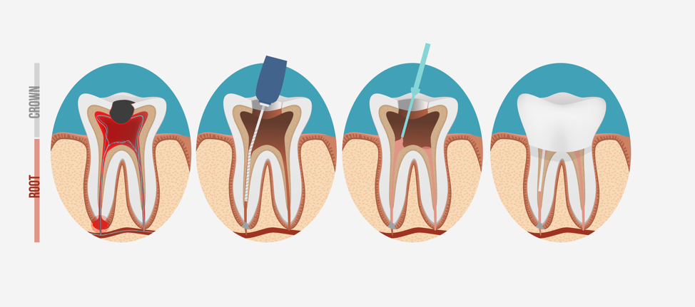 root-canal-process