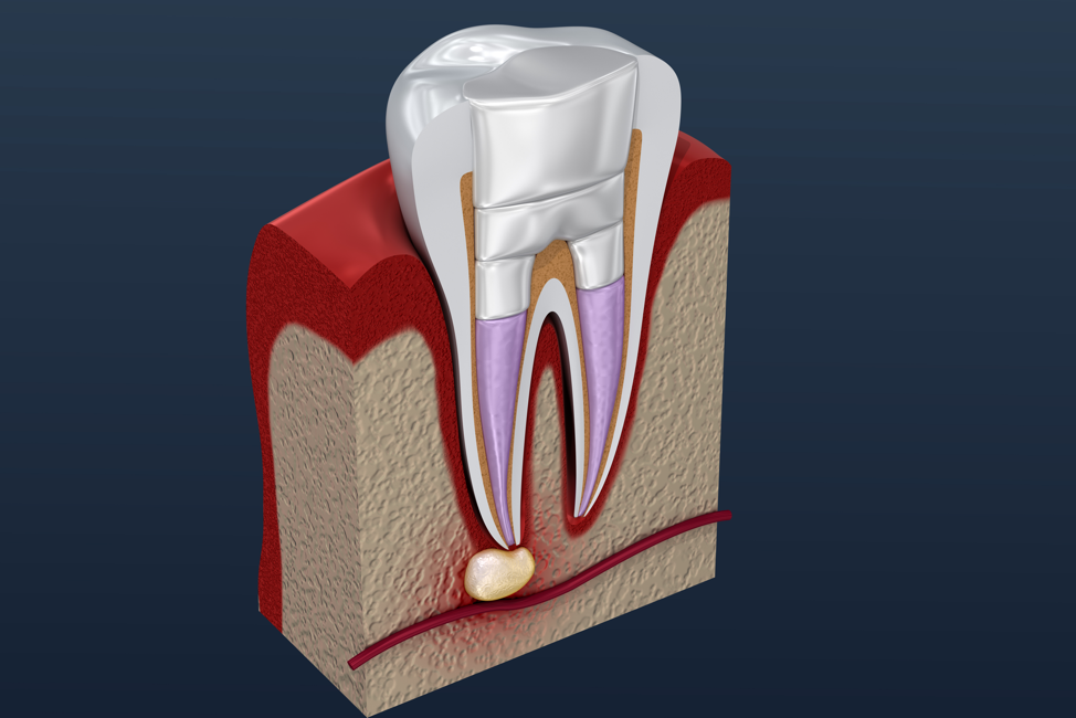 root-canal-procedure-diagram