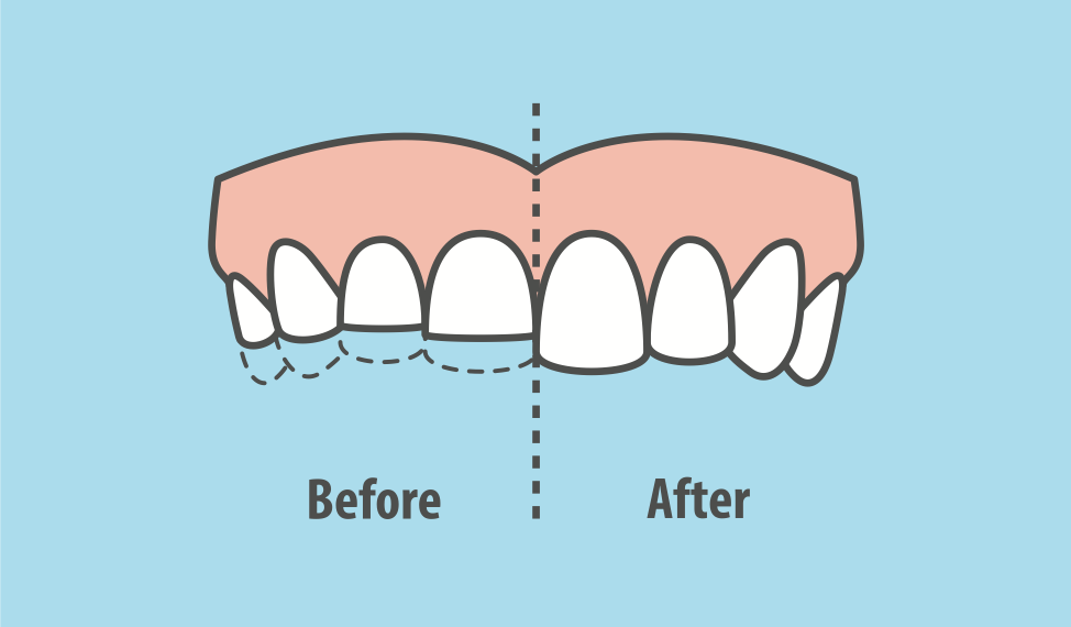 effects-of-teeth-grinding