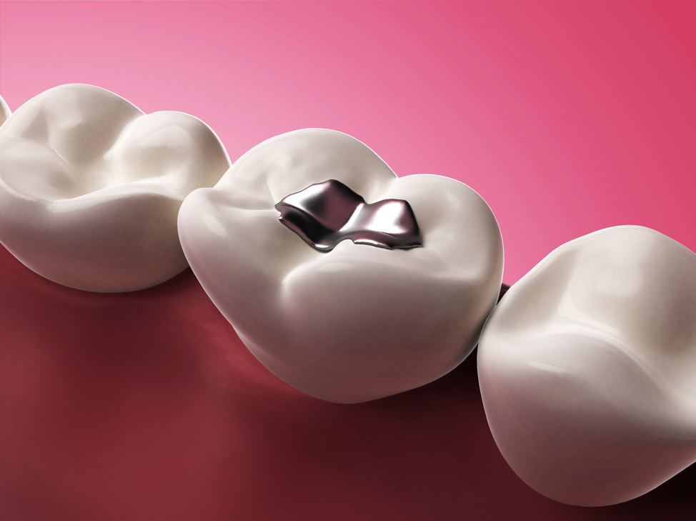 dental-cavity-filling-molar