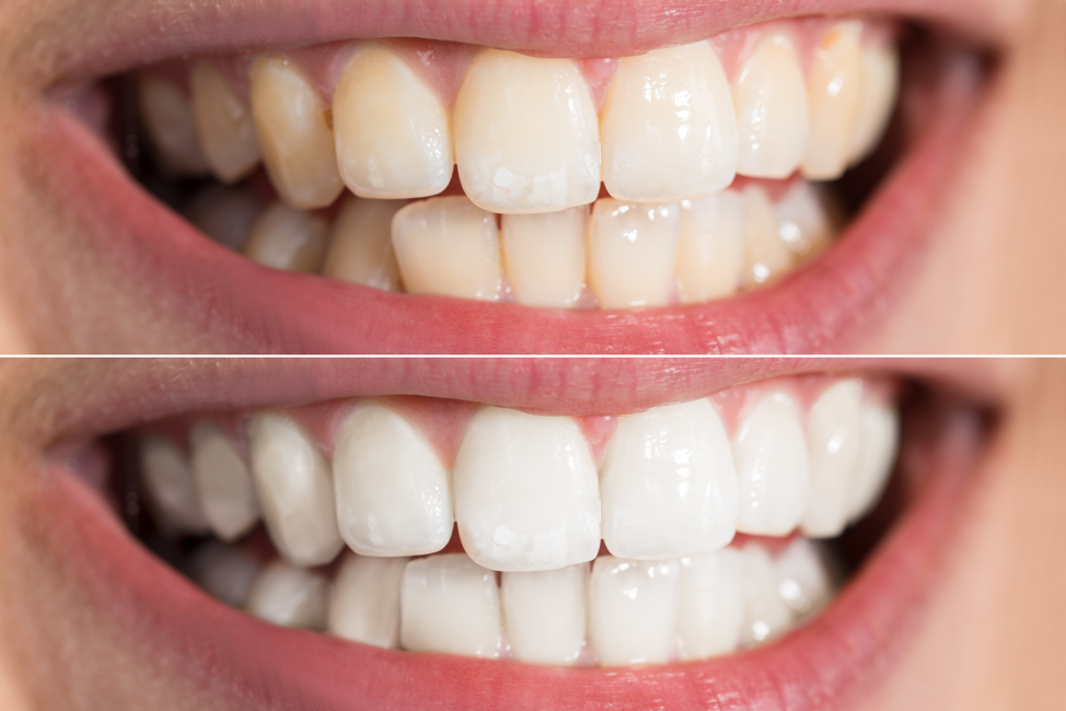 smokers teeth before and after