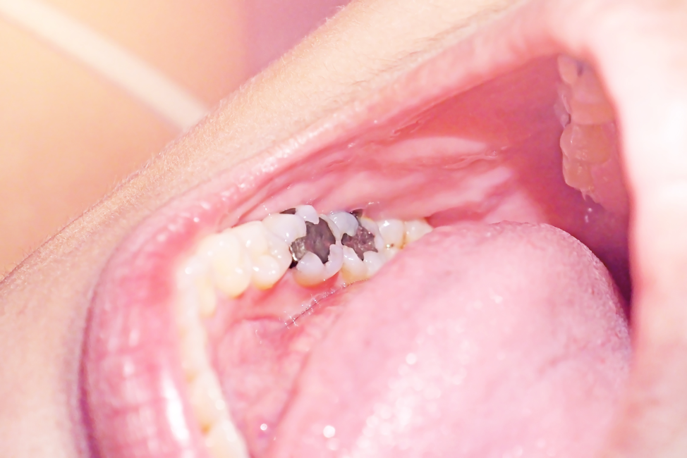 dental-cavities-fillings-evanston