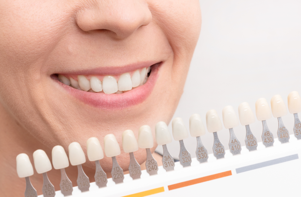 lincolnwood-teeth-whitening-dentist