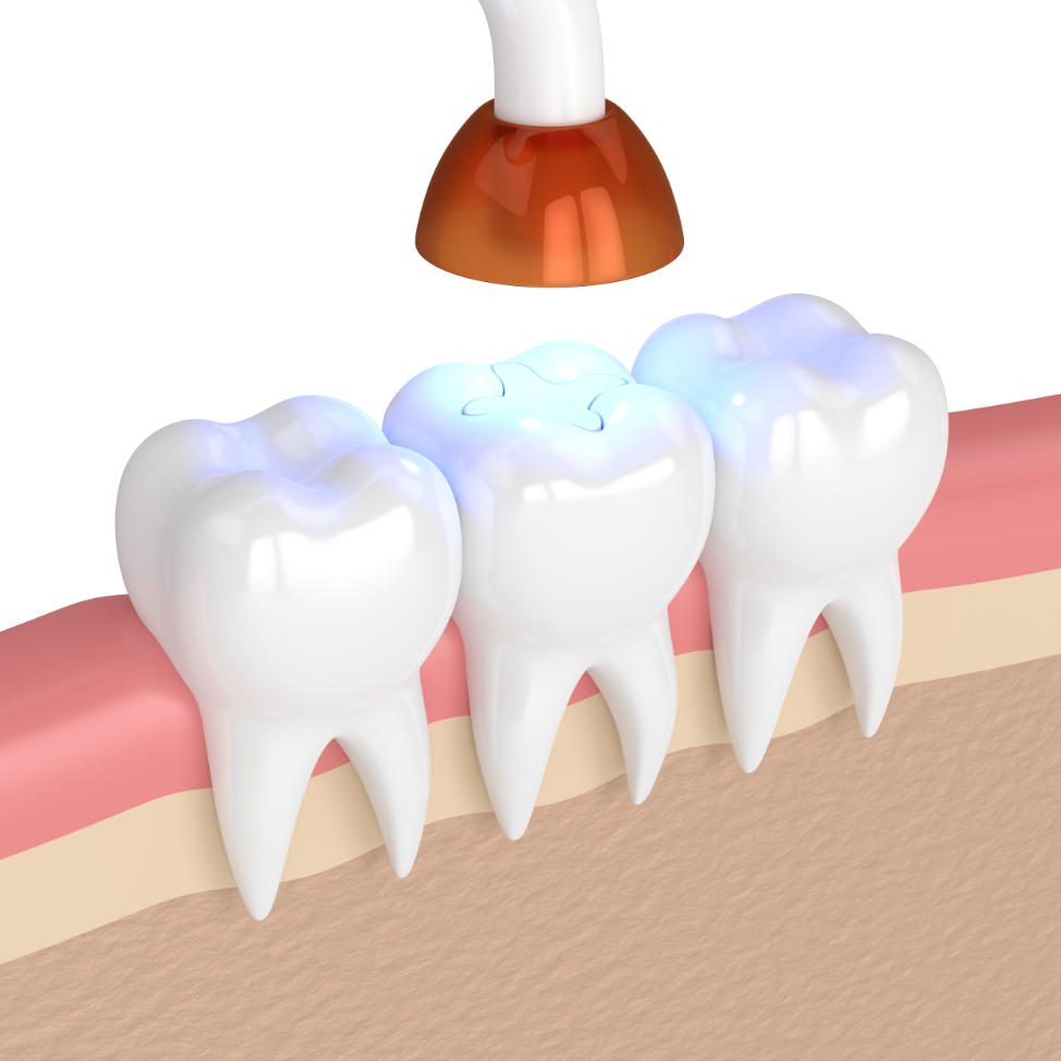 dental-cavities-rogers-park